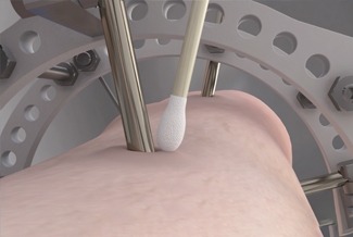 Preventing and Managing Pin Track Infection in External Fixation