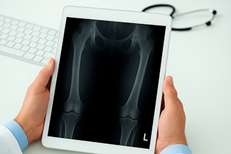 Retrograde Intramedullary Femur Lengthening with Fitbone™ Lengthening System: Tips and Tricks